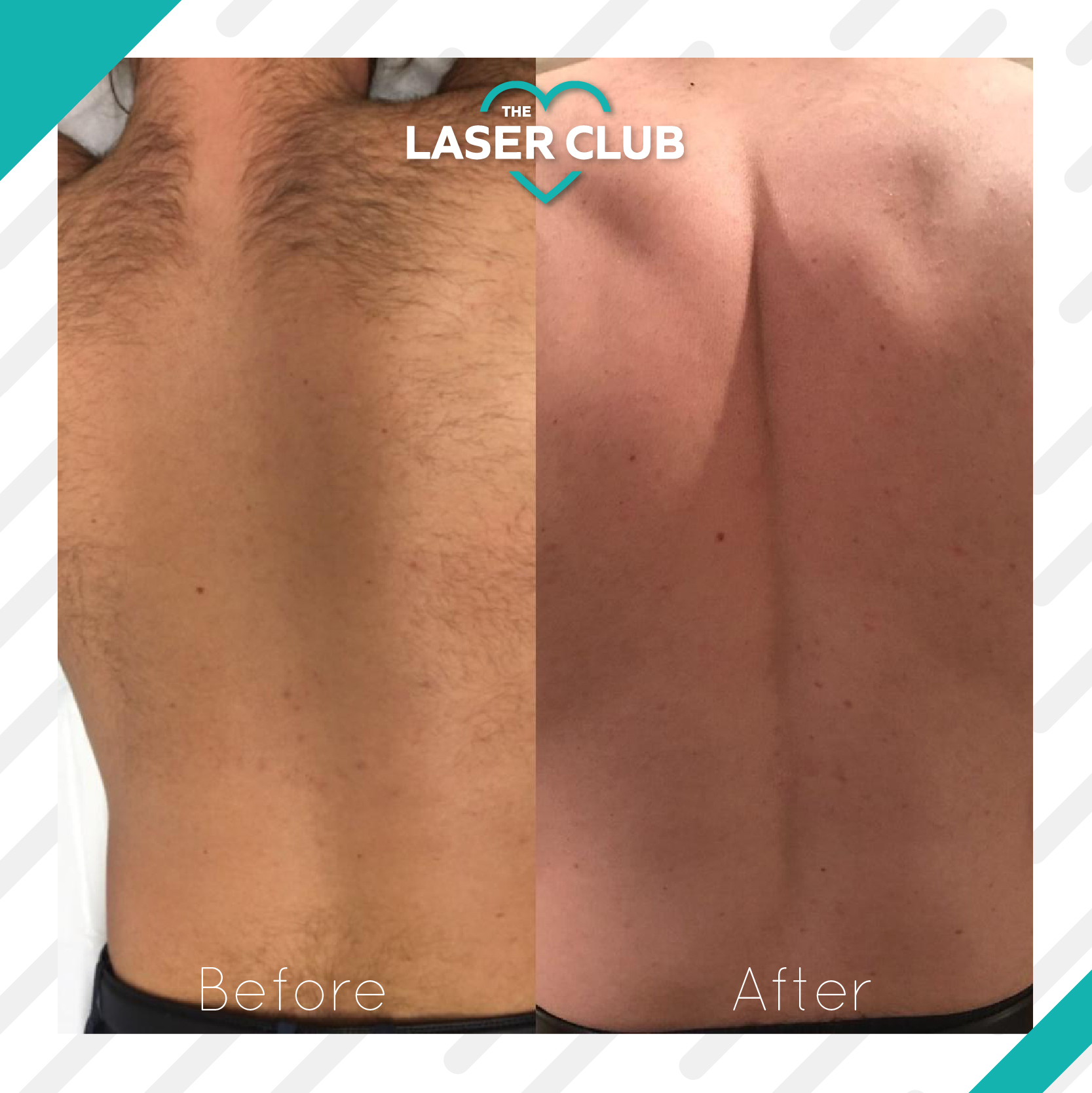Manchester Laser Hair Removal | Boombae